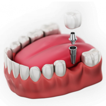 Cum functioneaza implantul dentar?